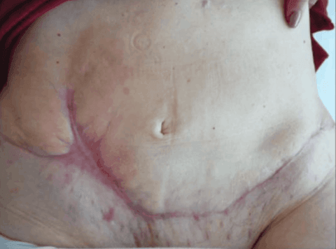 Imagen del artículo «Medicina hiperbárica en medicina estética y cirugía plástica»